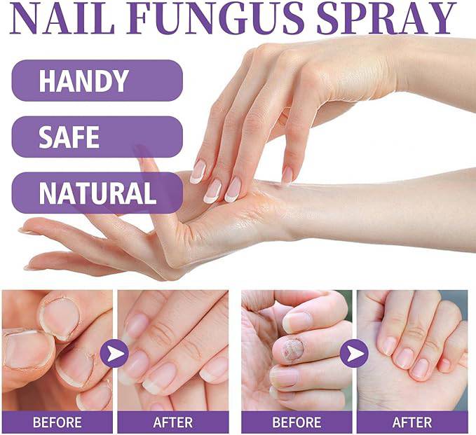 Nail Fungus Spray - Goldiesbliss