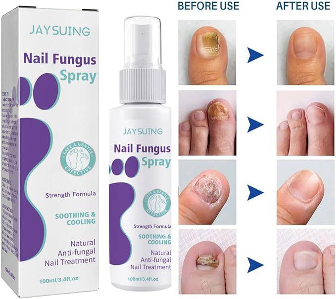 Nail Fungus Spray - Goldiesbliss